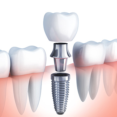 Dental Implants in Mesa